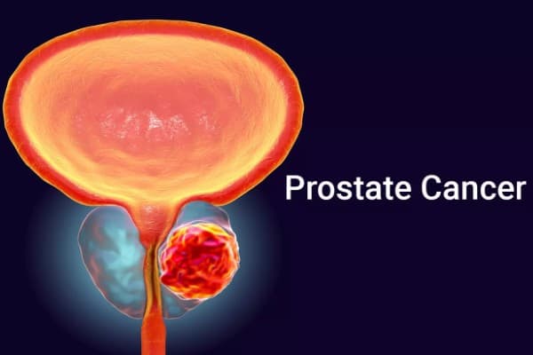 Know More About Prostate Cancer Treatment