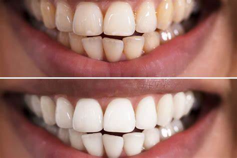 Teeth Whitening Tips