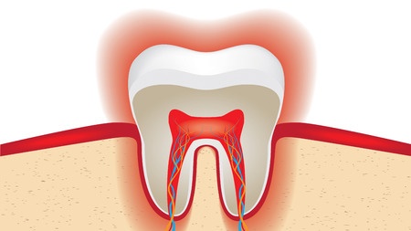 Tooth Sensitivity