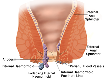 haemorrhoids